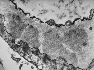 F,49y. | membranous glomerulopathy F,49y. | membranous glomerulopathy